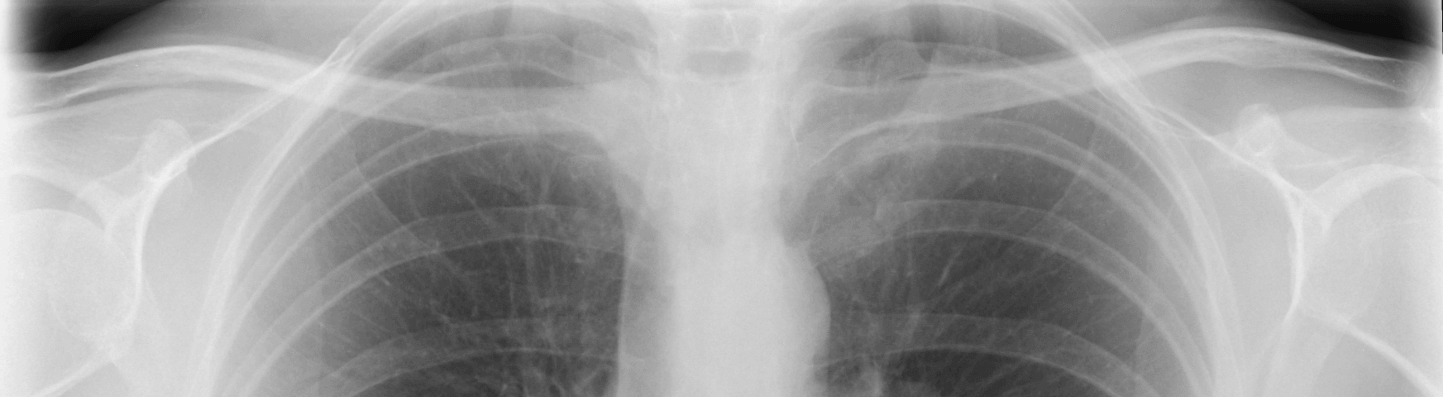 clavicle mass