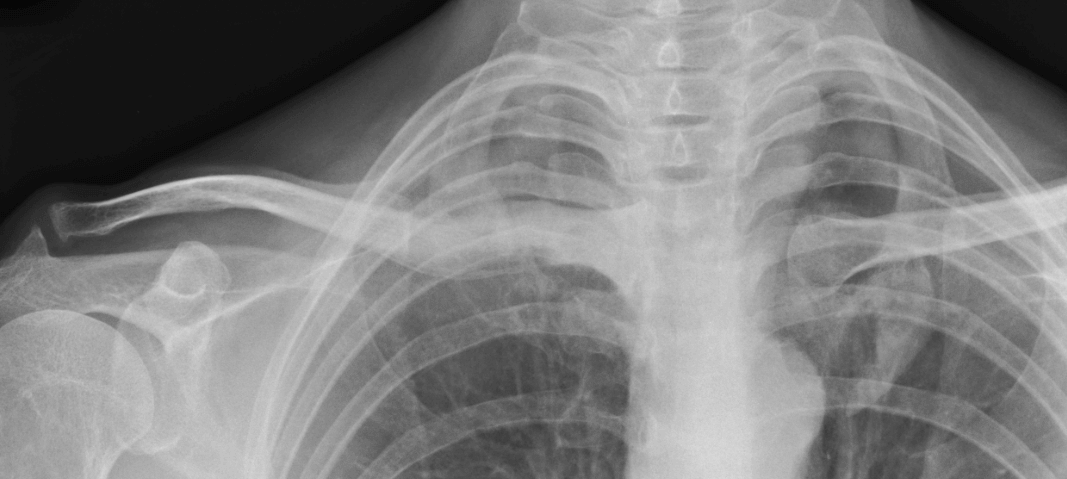 clavicle mass