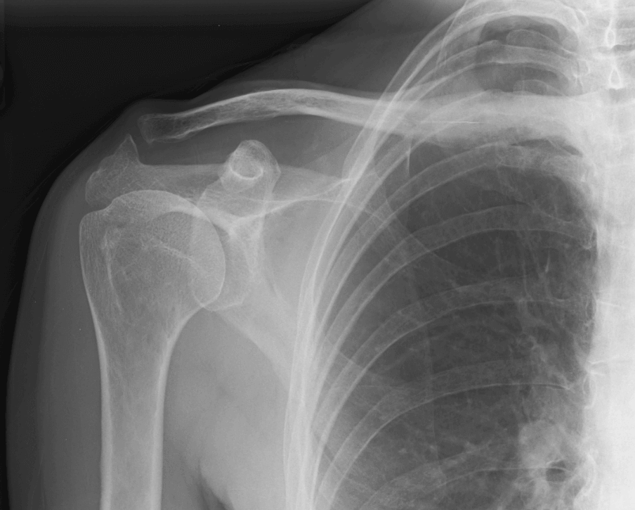 clavicle mass