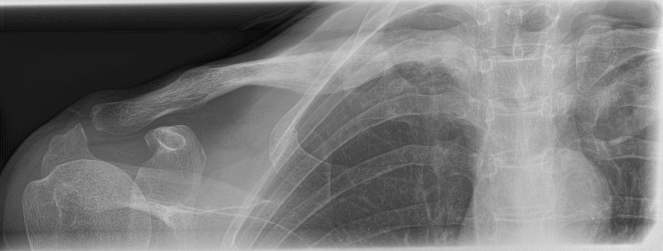 clavicle mass