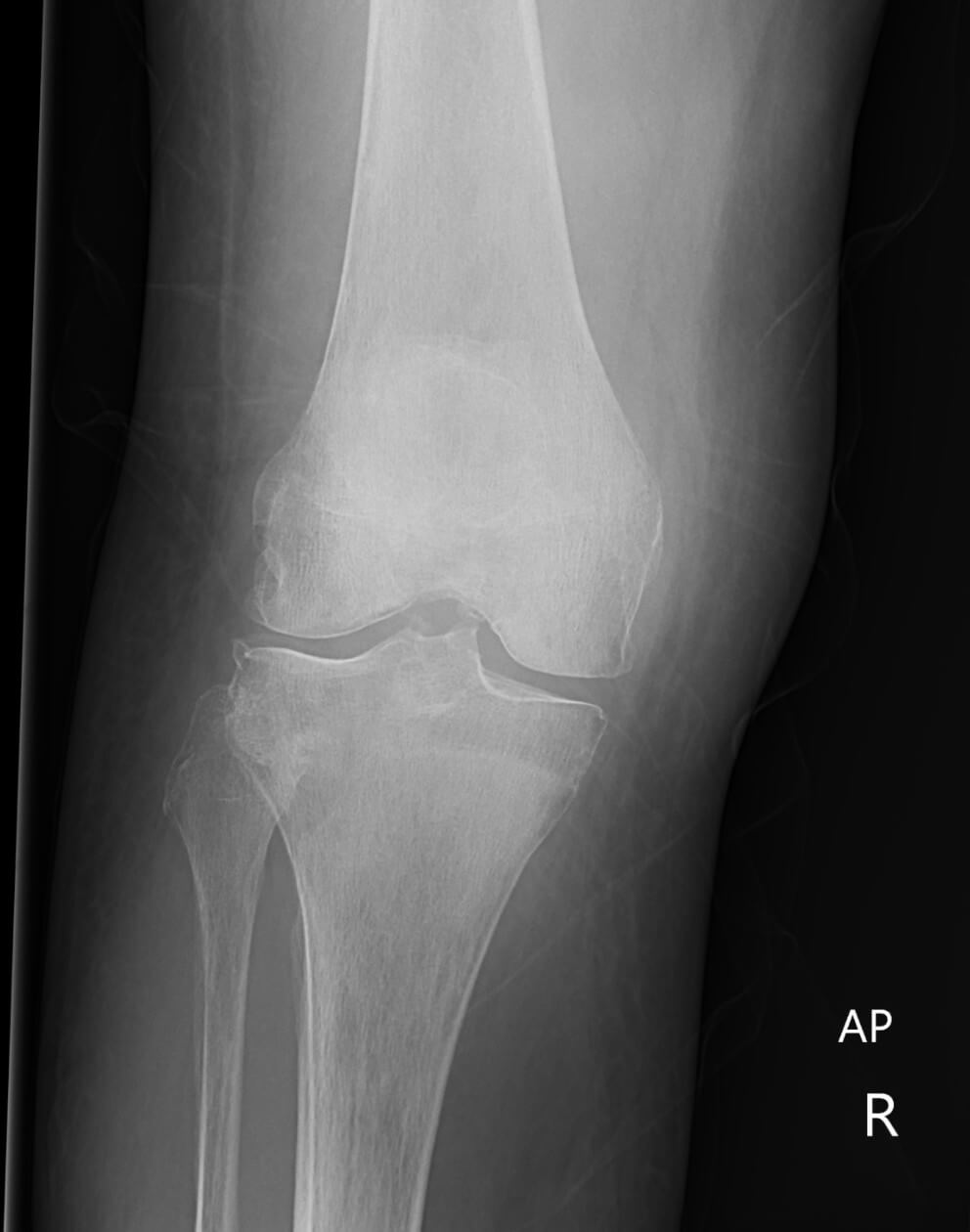 left knee transient synovitis icd 10