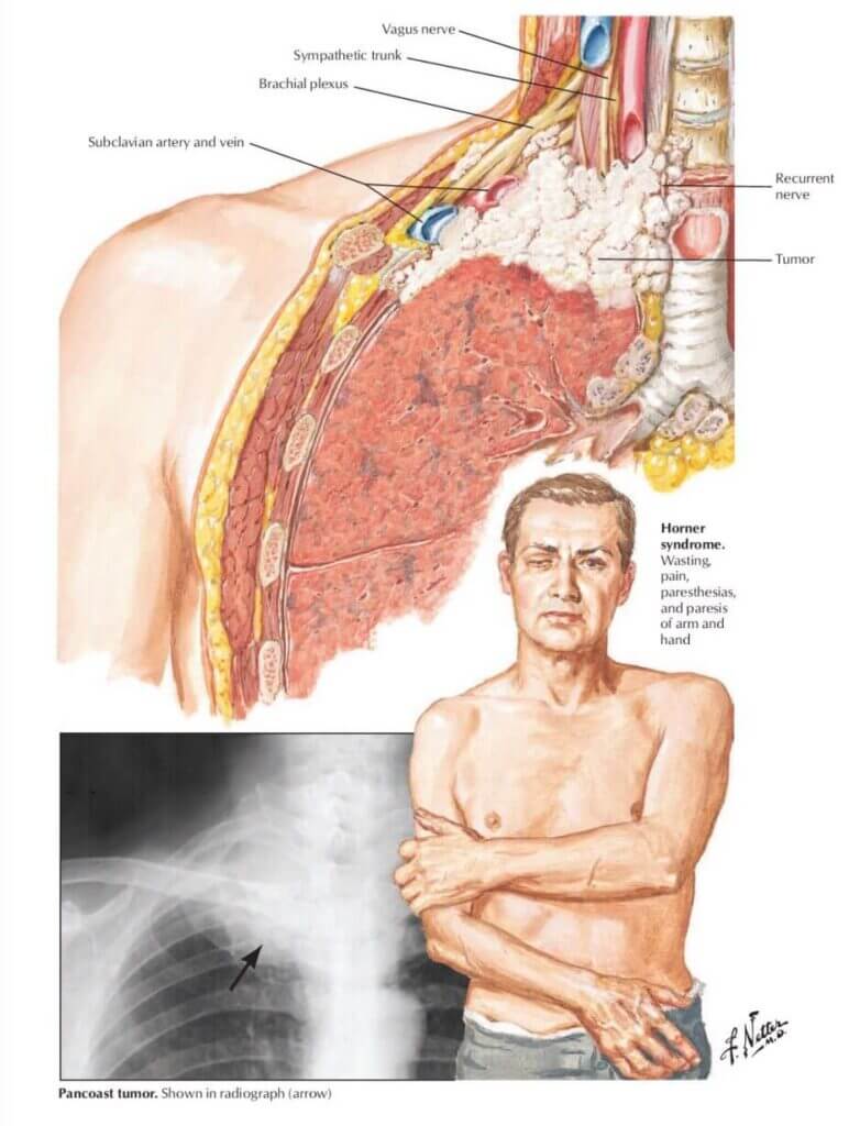 Lung Cancer Pancoast Home