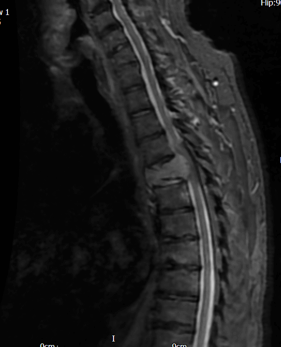 Plasmacytoma