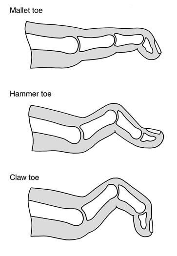 toe deformity